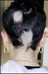 calva.jpg